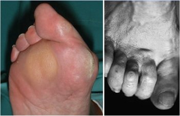 douleur au pied Kelaide Semelles Orthopédiques pour homme et femme métatarsalgie soutien de la voûte plantaire pour pieds plats fasciite plantaire 